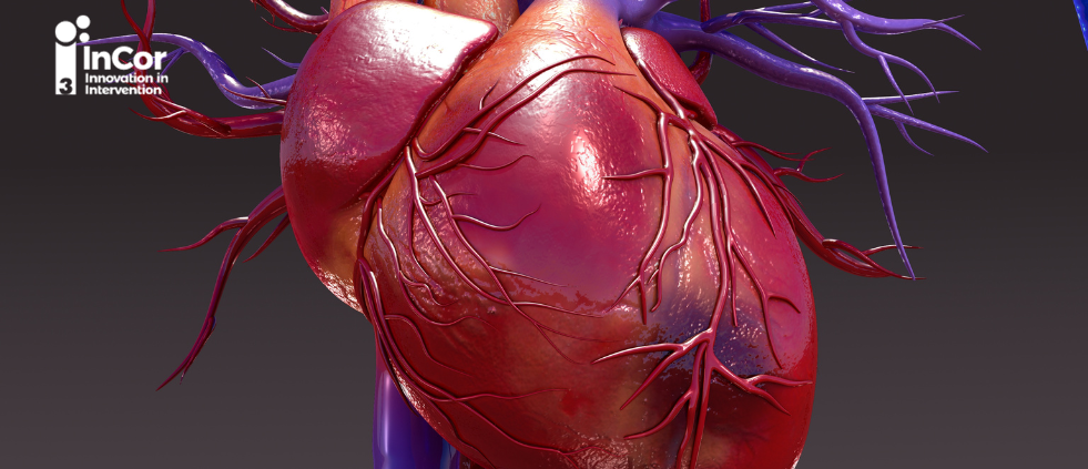 Revascularização no paciente com choque cardiogênico pós-IAM