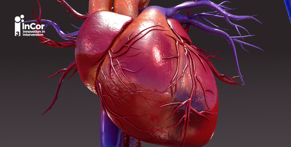 Revascularização no paciente com choque cardiogênico pós-IAM