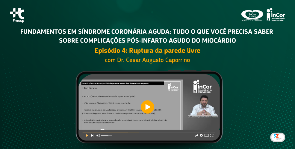 Fundamentos em Síndrome Coronária Aguda: tudo o que você precisa saber sobre complicações pós-infarto agudo do miocárdio – Episódio 4: Ruptura da parede livre